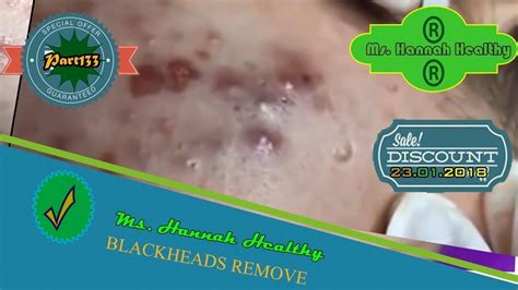 why is blackhead removal satisfying|Why You Can't Stop Watching Those Pimple.